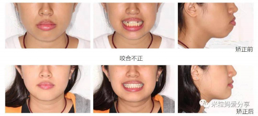 补完牙用沟窝封闭吗多少钱,牙齿封闭窝沟缺点是什么(图1)
